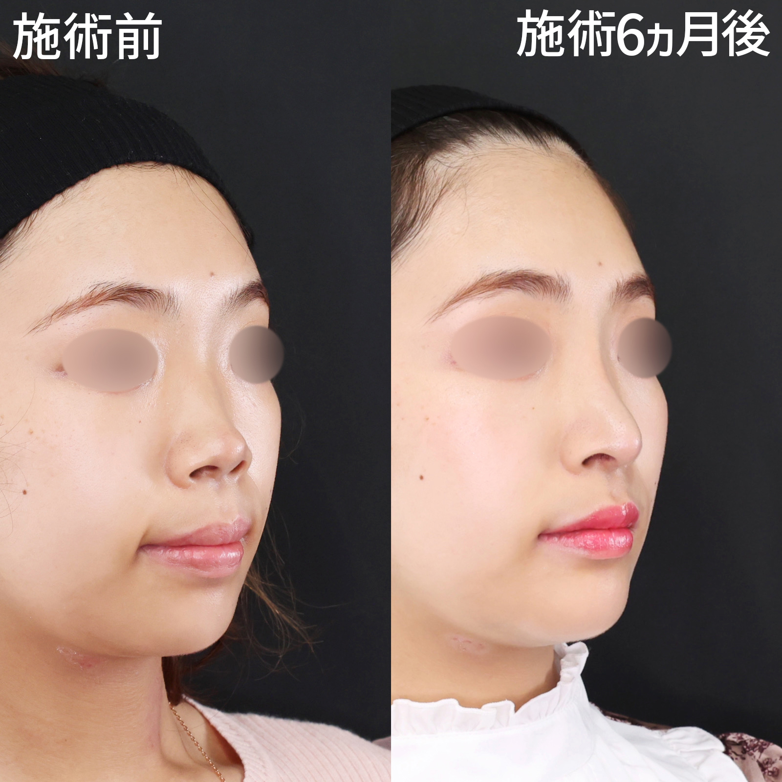 鼻中隔延長術/鼻先軟骨移植/鼻尖形成・鼻尖縮小の症例写真 施術前後 