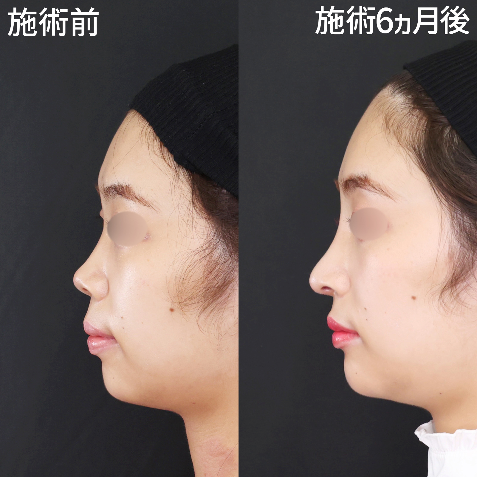 鼻中隔延長術/鼻先軟骨移植/鼻尖形成・鼻尖縮小の症例写真 施術前後 
