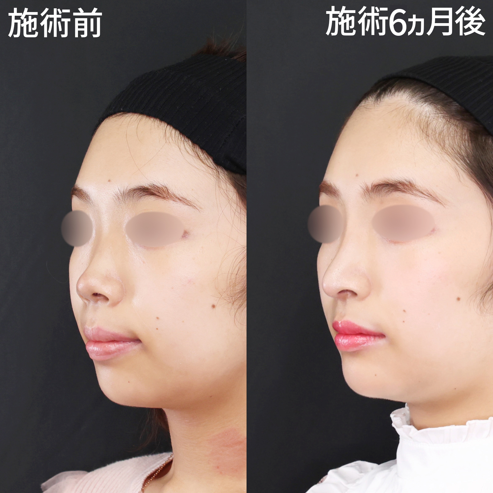 鼻中隔延長術/鼻先軟骨移植/鼻尖形成・鼻尖縮小の症例写真 施術前後 