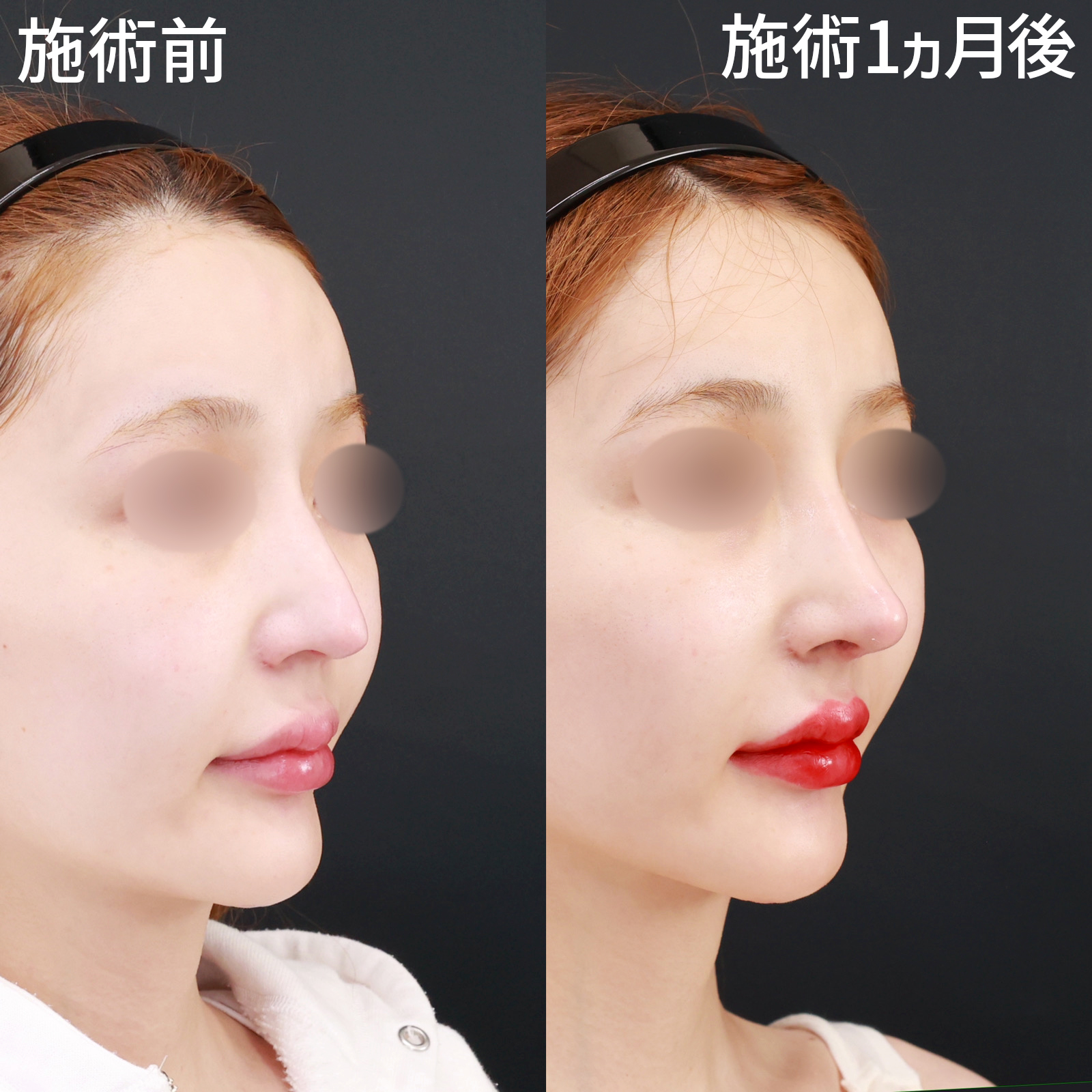 鼻中隔延長術/鼻先軟骨移植/鼻尖形成・鼻尖縮小の症例写真 施術前後 