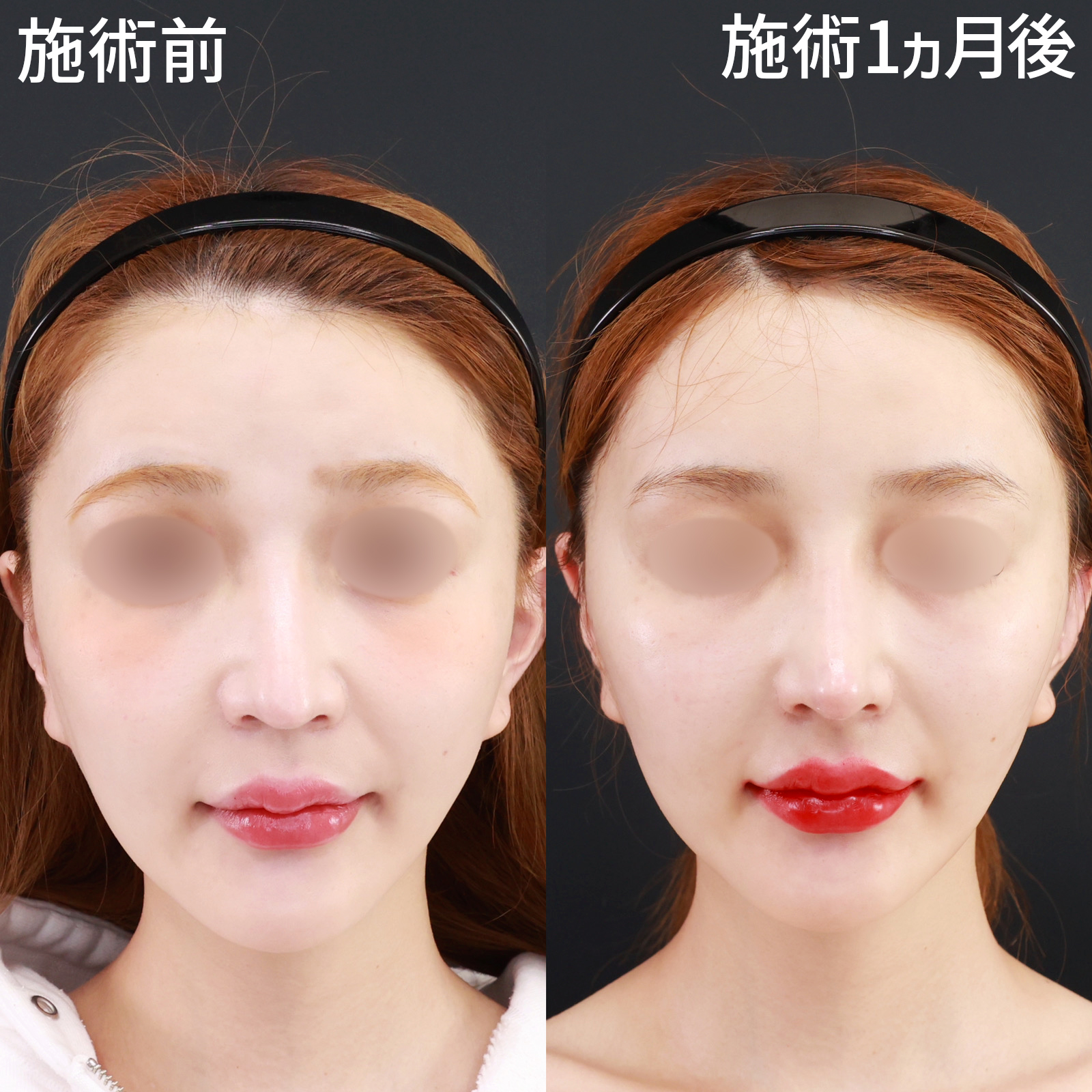 鼻中隔延長術/鼻先軟骨移植/鼻尖形成・鼻尖縮小の症例写真 施術前後 