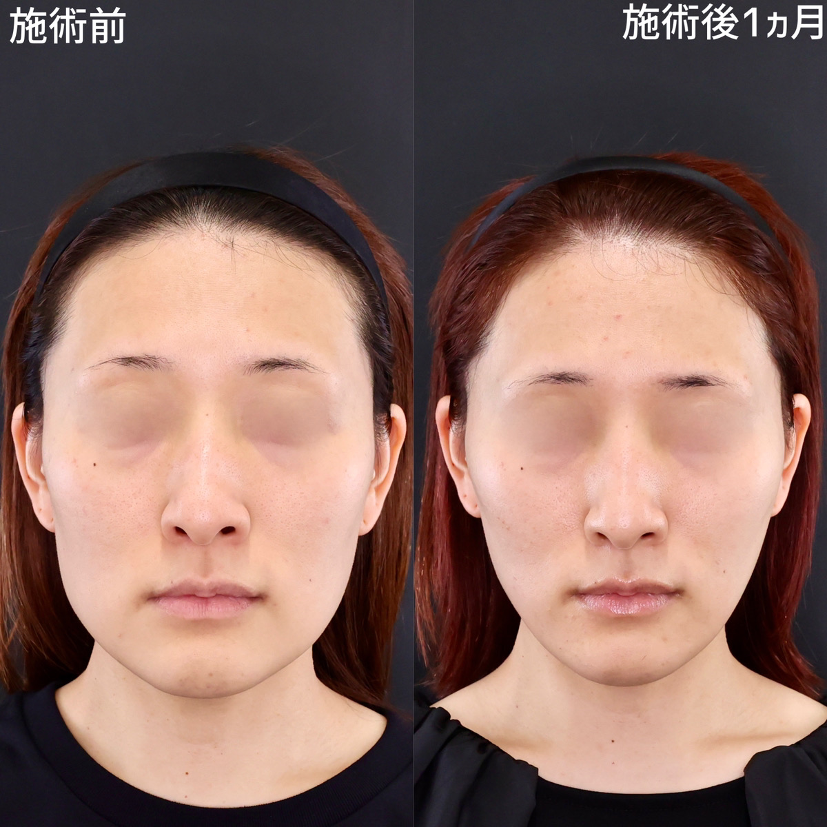 【糸リフト×ボトックス】ダウンタイムが少ない小顔整形！