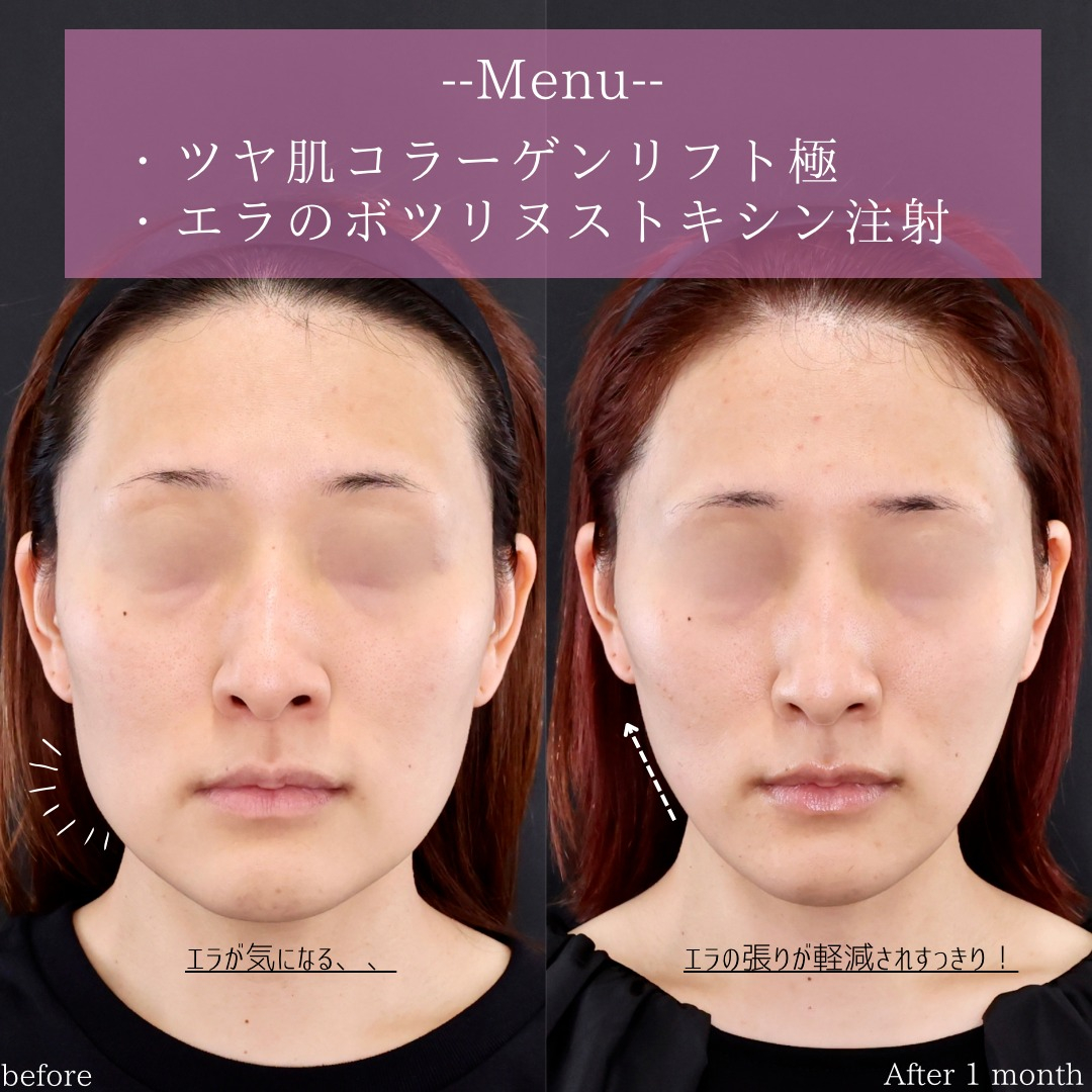 TAC式 ツヤ肌コラーゲンリフト®/エラボトックス注射の症例写真 施術前後 