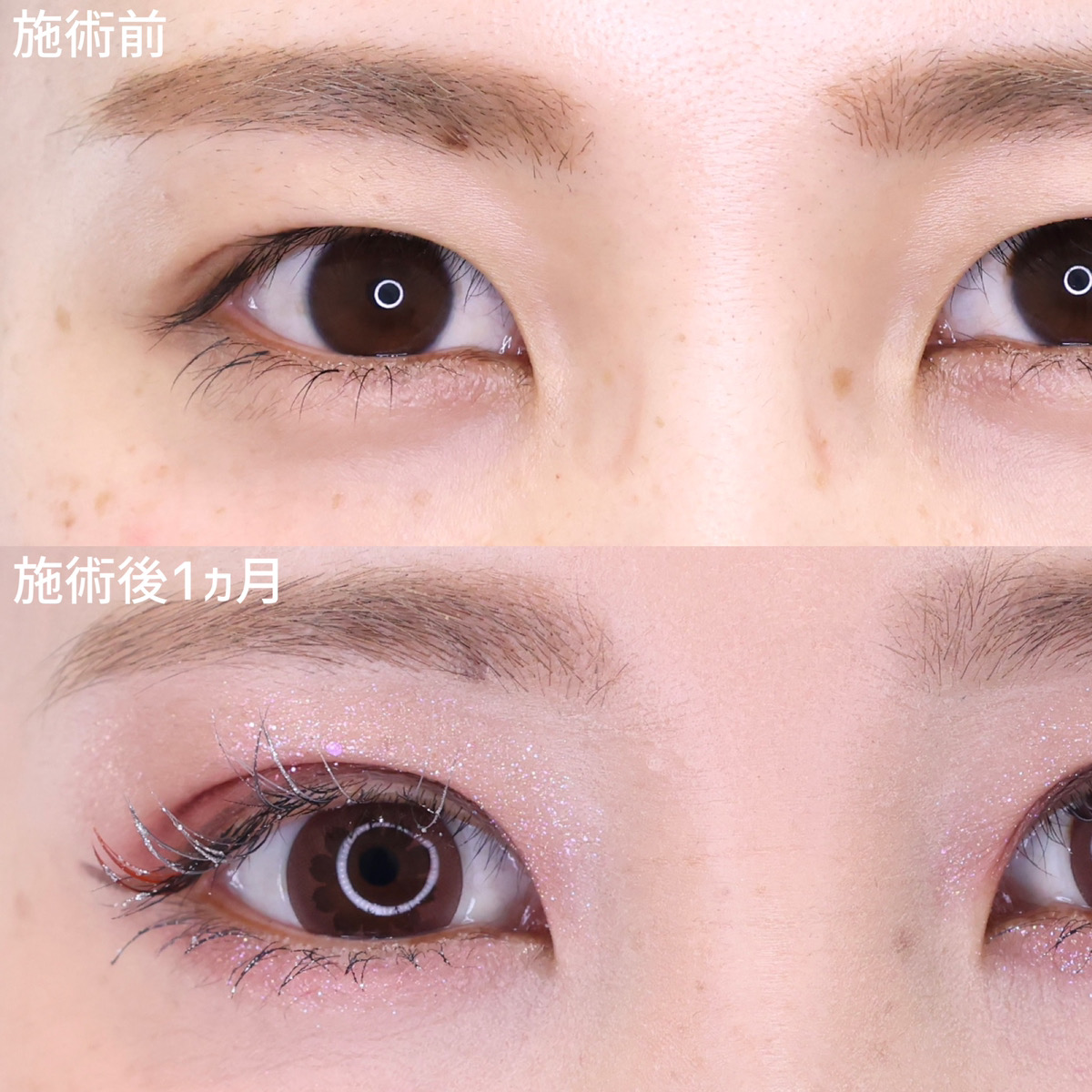 二重埋没法の症例写真 施術前後 