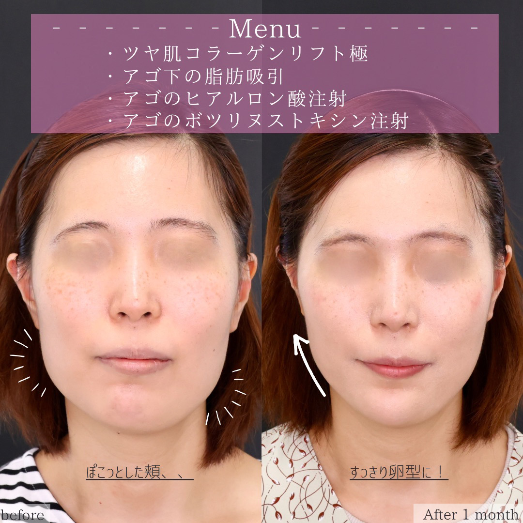 TAC式 ツヤ肌コラーゲンリフト®/顎下の脂肪吸引/顎のヒアルロン酸注射の症例写真 施術前後 