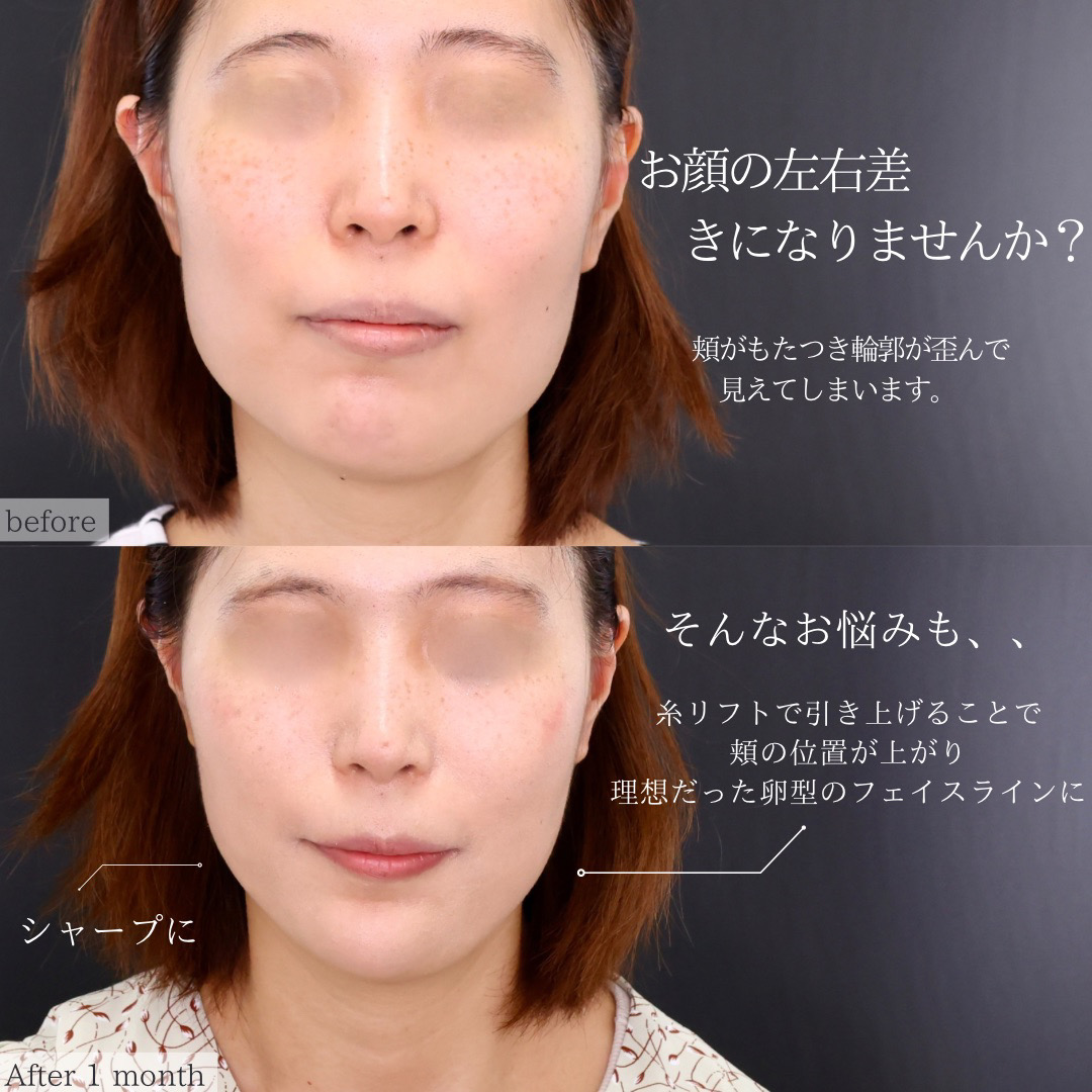 TAC式 ツヤ肌コラーゲンリフト®/顎下の脂肪吸引/顎のヒアルロン酸注射の症例写真 施術前後 