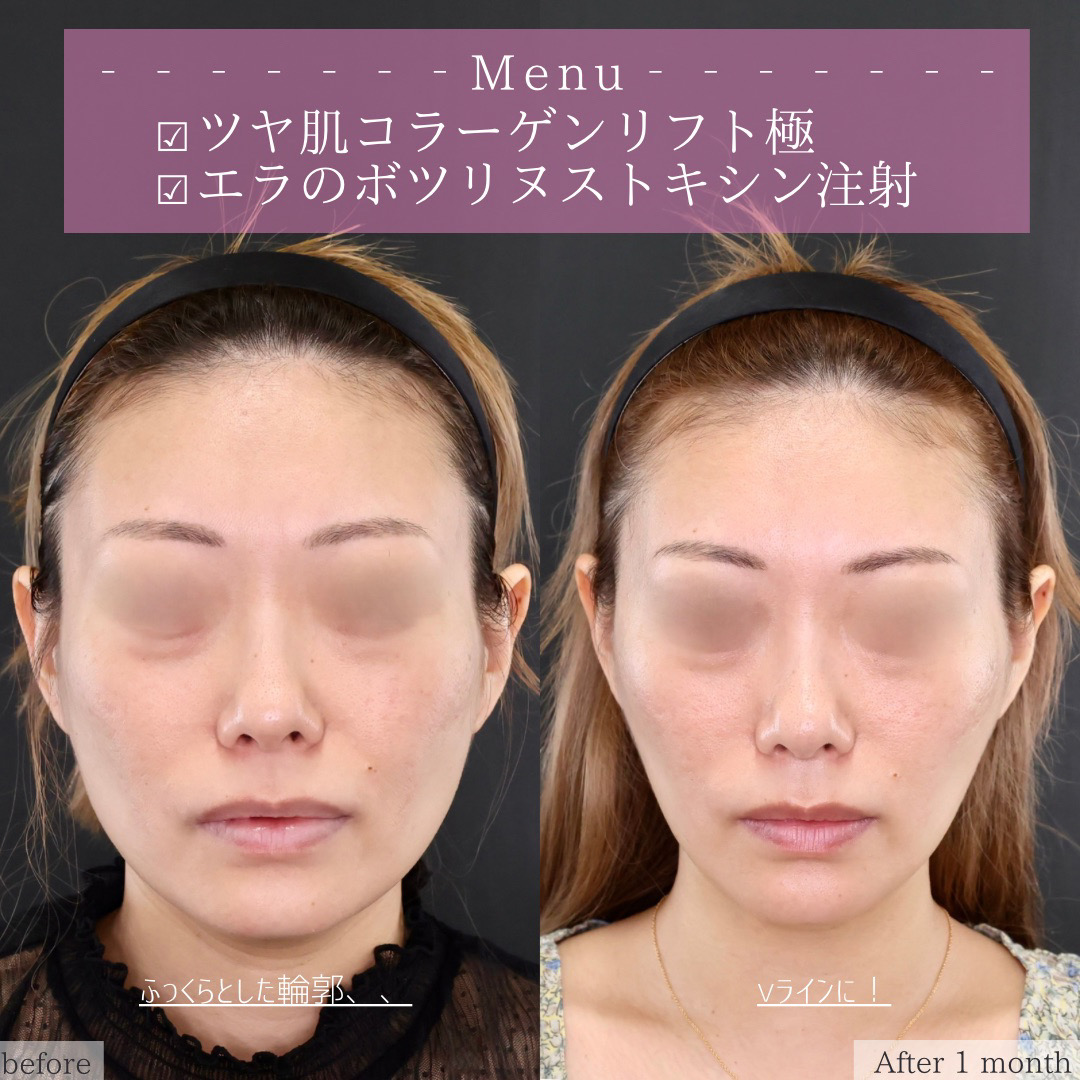TAC式 ツヤ肌コラーゲンリフト®/エラボトックス注射の症例写真 施術前後 