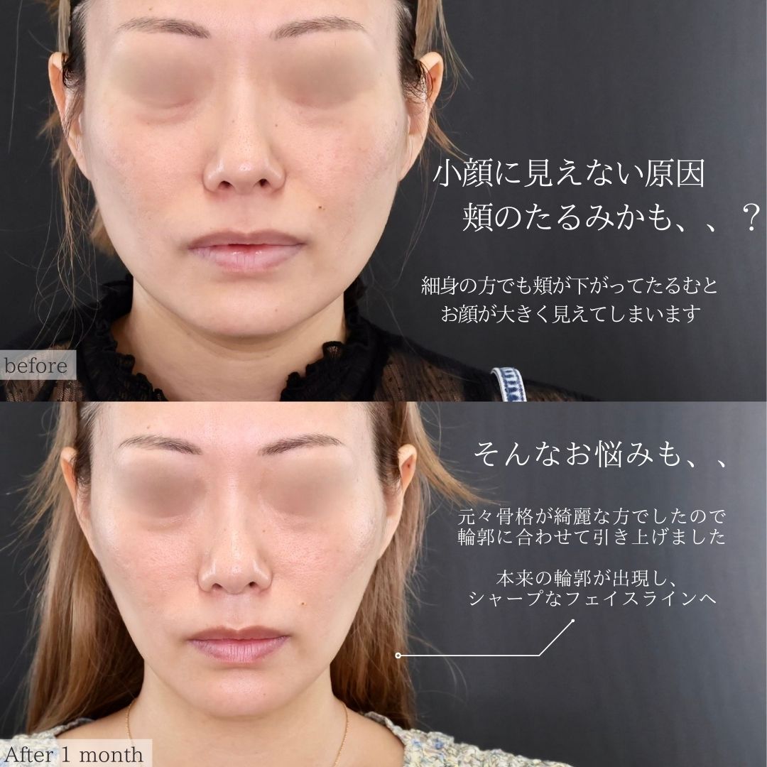 TAC式 ツヤ肌コラーゲンリフト®/エラボトックス注射の症例写真 施術前後 