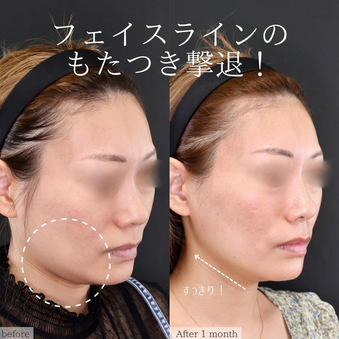 TAC式 ツヤ肌コラーゲンリフト®/エラボトックス注射の症例写真 施術前後 