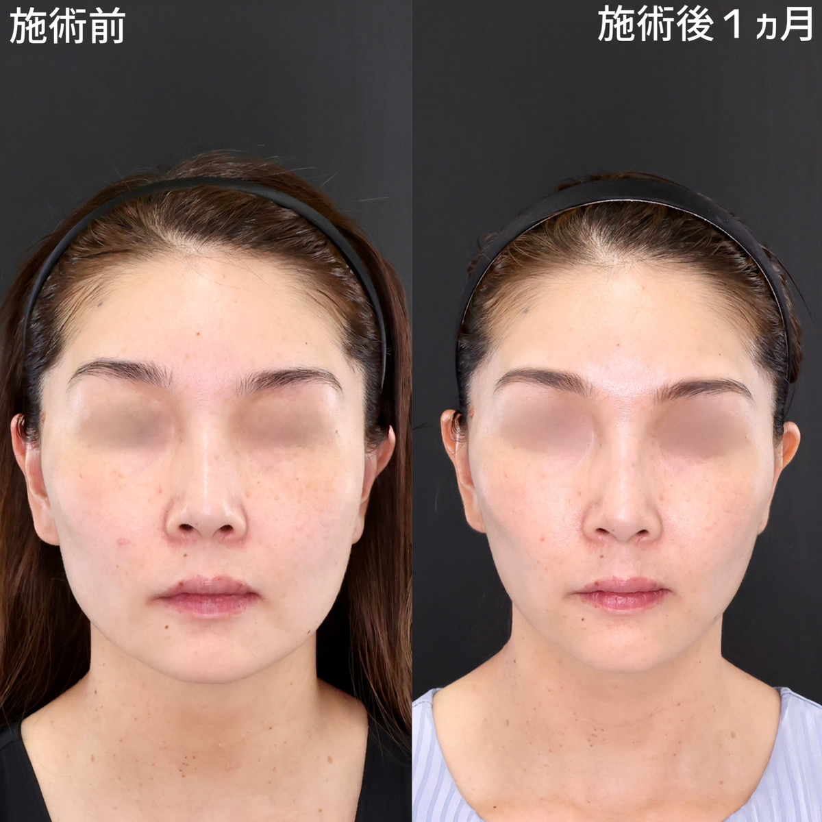 エラの張り改善でお顔の横幅縮小！綺麗な卵型フェイスへ