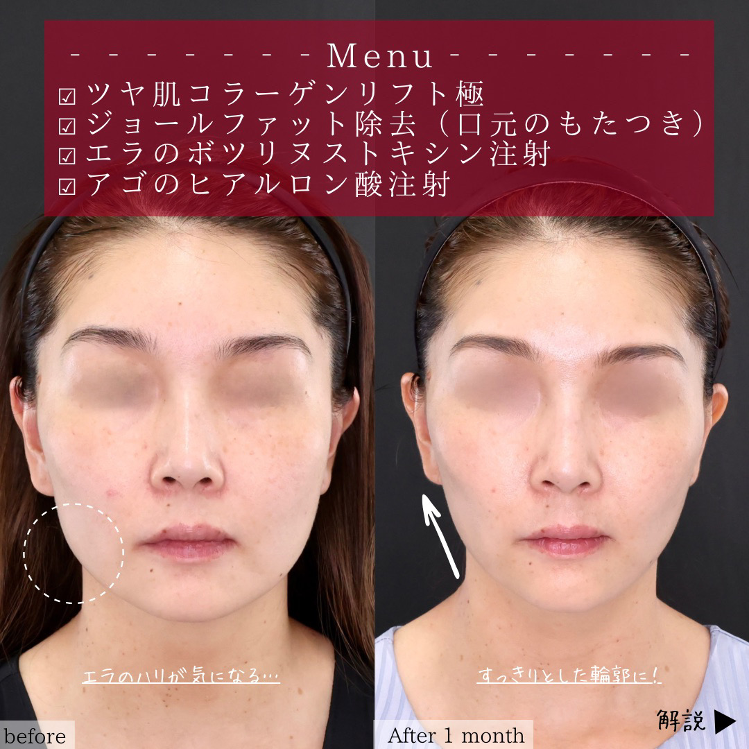 TAC式 ツヤ肌コラーゲンリフト®/ジョールファット除去/エラボトックス注射の症例写真 施術前後 