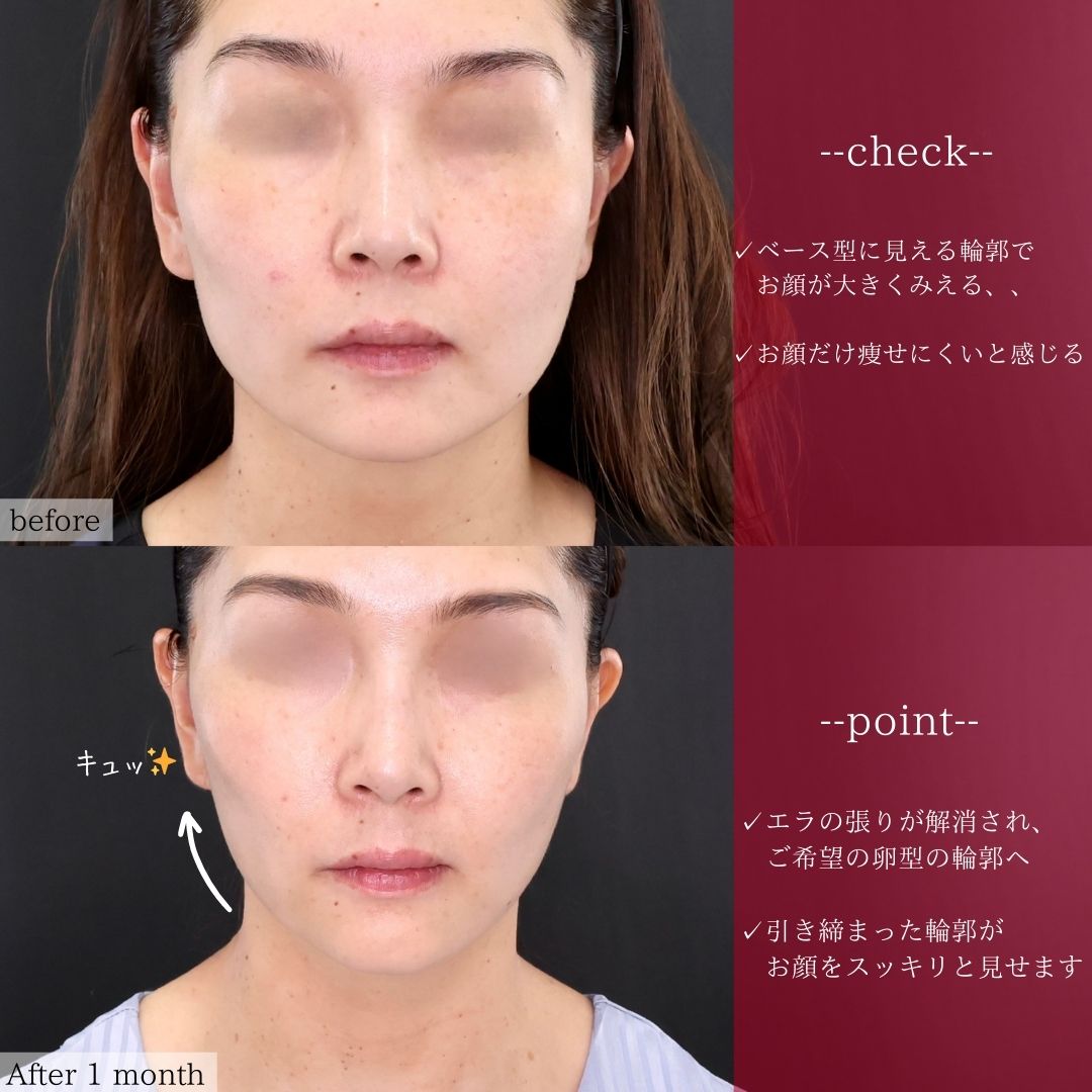 TAC式 ツヤ肌コラーゲンリフト®/ジョールファット除去/エラボトックス注射の症例写真 施術前後 