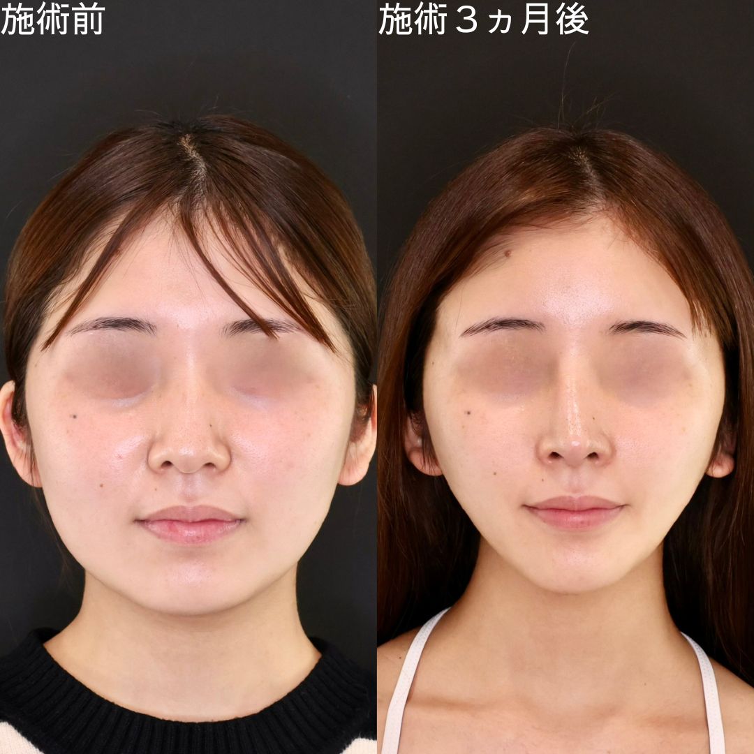 小顔整形｜パーフェクトフェイスライン/バッカルファット除去/ジョールファット除去の症例写真 施術前後 