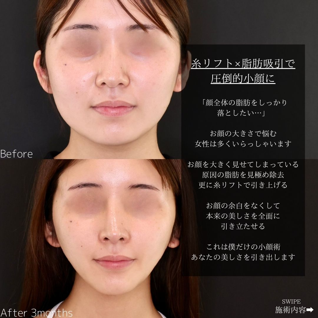 小顔整形｜パーフェクトフェイスライン/バッカルファット除去/ジョールファット除去の症例写真 施術前後 