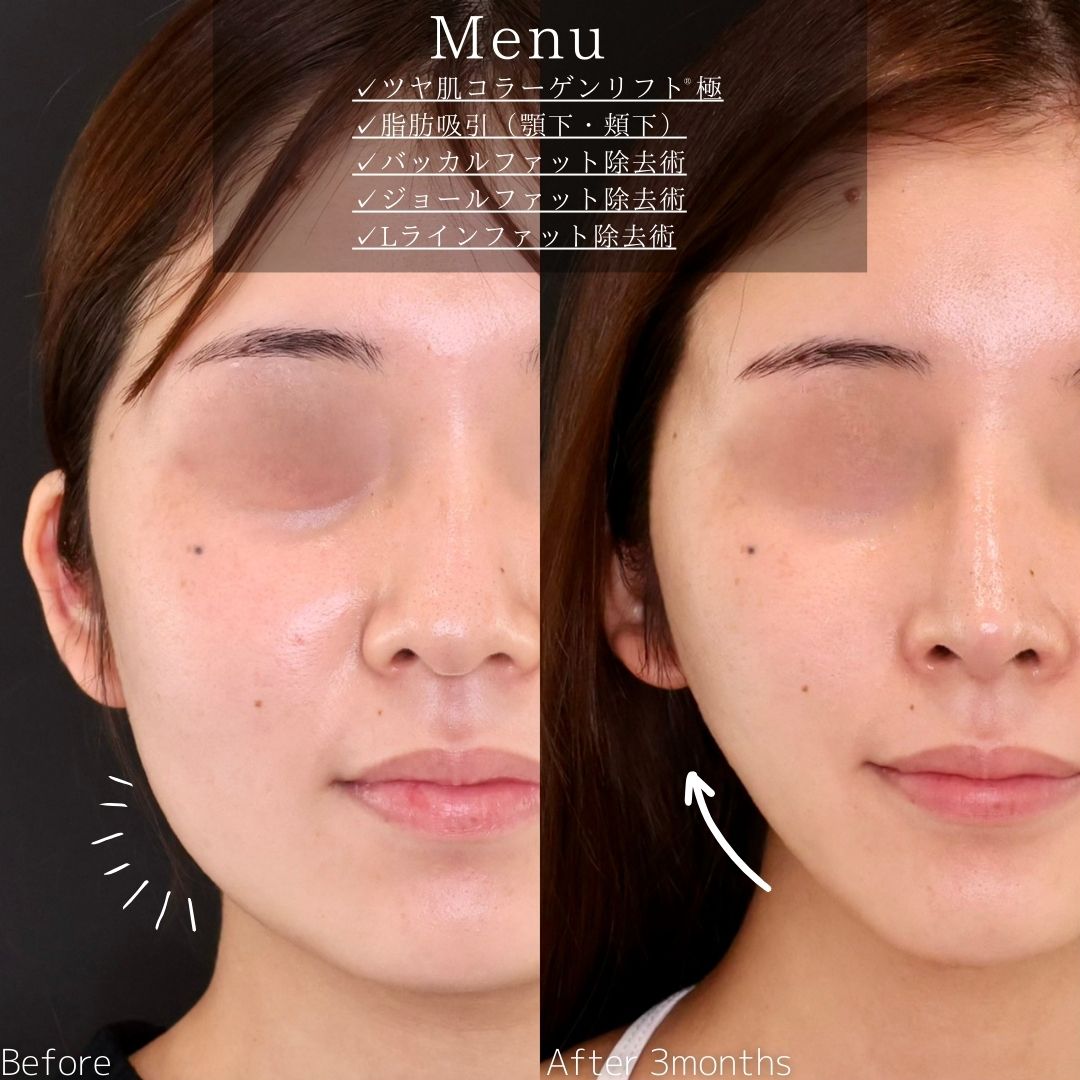 小顔整形｜パーフェクトフェイスライン/バッカルファット除去/ジョールファット除去の症例写真 施術前後 