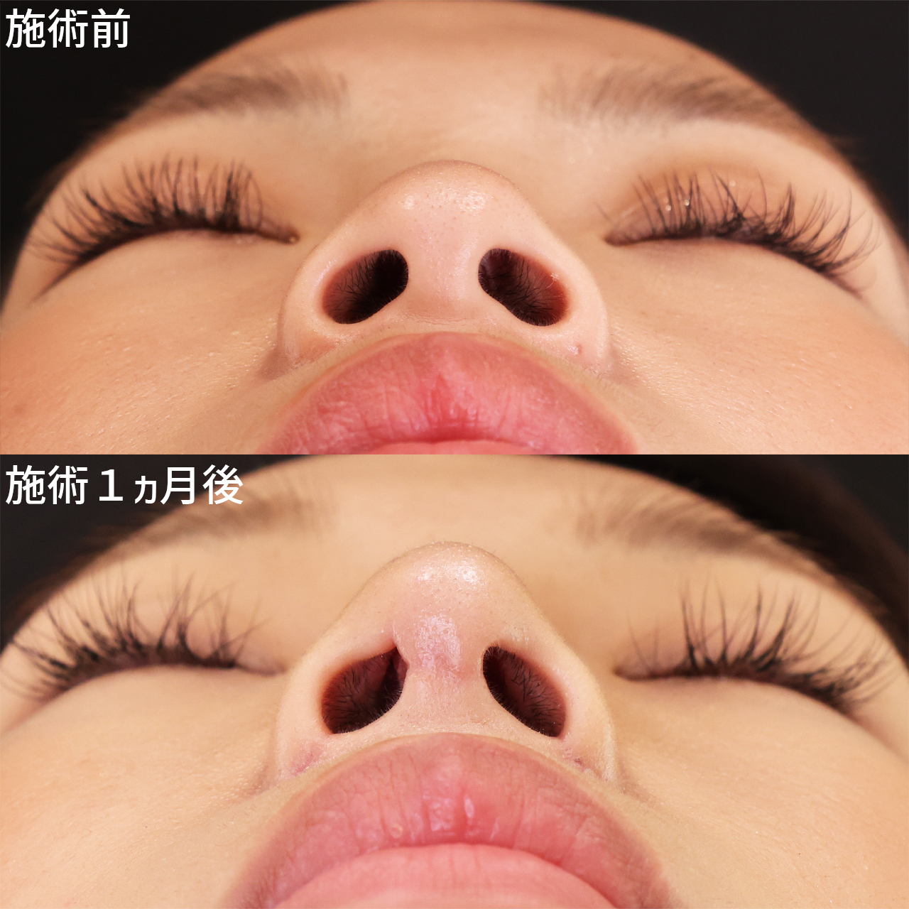 洗練されたお鼻に。お鼻のトータルビューティー