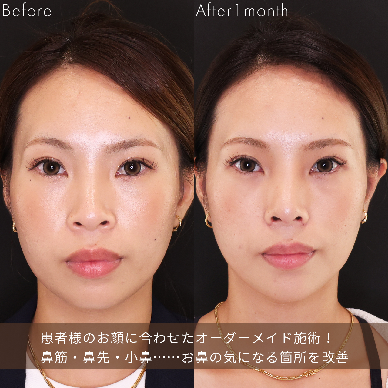 鼻尖形成・鼻尖縮小/鼻先軟骨移植/隆鼻術（プロテーゼ・自家組織）の症例写真 施術前後 