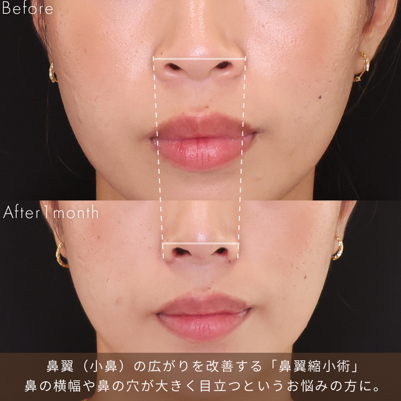 鼻尖形成・鼻尖縮小/鼻先軟骨移植/隆鼻術（プロテーゼ・自家組織）の症例写真 施術前後 