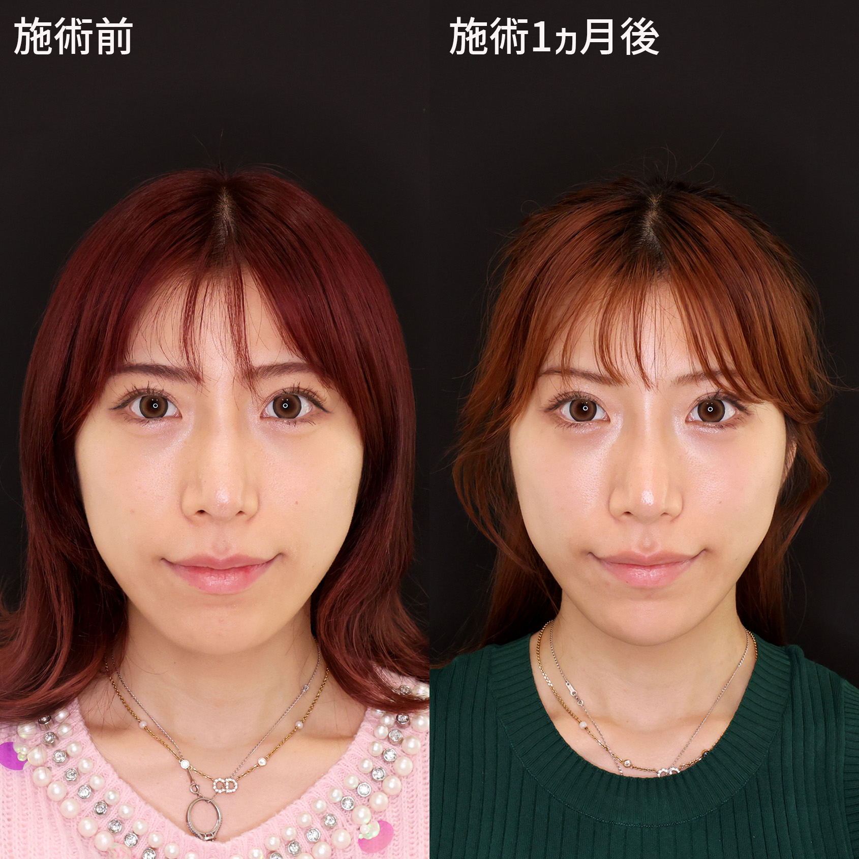 【小顔複合施術】で可愛い卵型フェイスラインを手に入れる♪