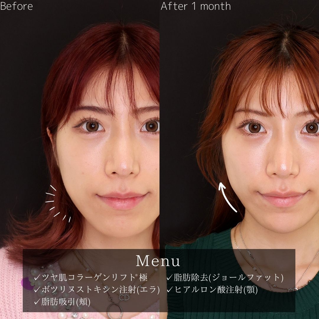 小顔整形｜パーフェクトフェイスライン/TAC式 ツヤ肌コラーゲンリフト®/ジョールファット除去の症例写真 施術前後 