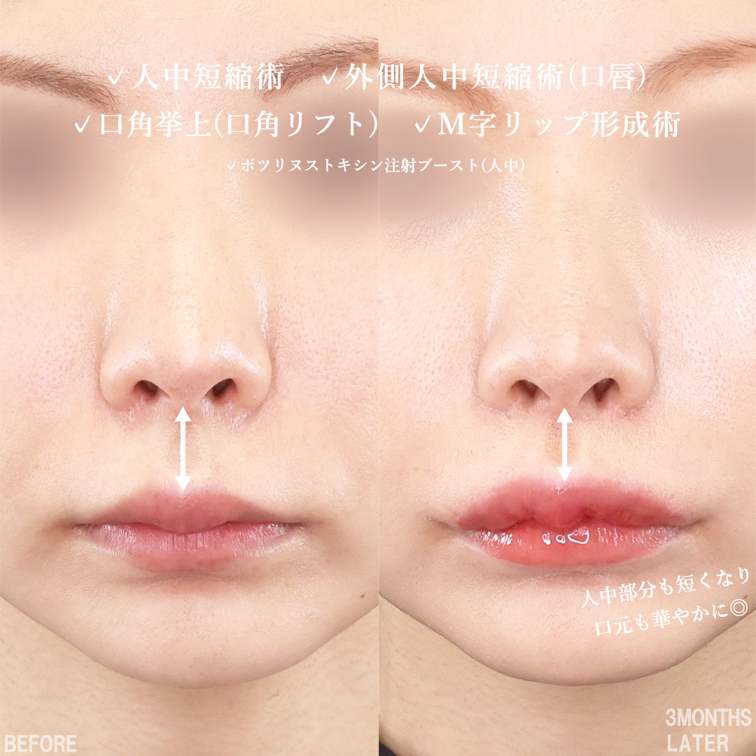 人中短縮術(リップリフト)・外側人中短縮術/M字リップ形成術/口角挙上・リフト（マイクロ切開法・内側法/口内法）の症例写真 施術前後 