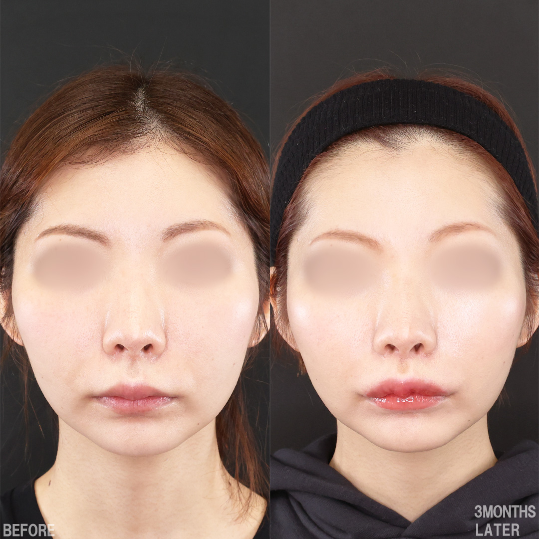 人中短縮術(リップリフト)・外側人中短縮術/M字リップ形成術/口角挙上・リフト（マイクロ切開法・内側法/口内法）の症例写真 施術前後 