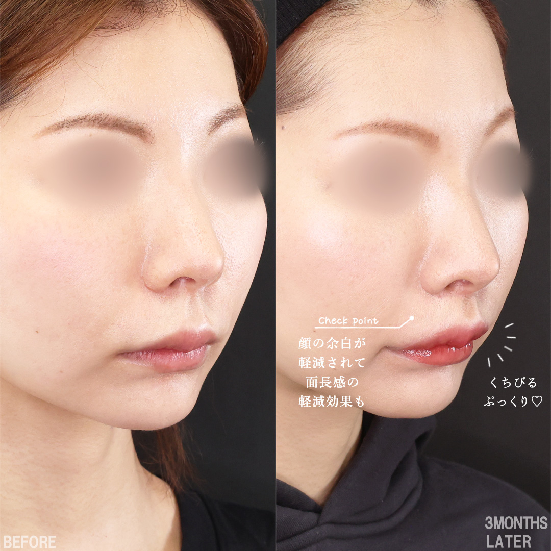 人中短縮術(リップリフト)・外側人中短縮術/M字リップ形成術/口角挙上・リフト（マイクロ切開法・内側法/口内法）の症例写真 施術前後 