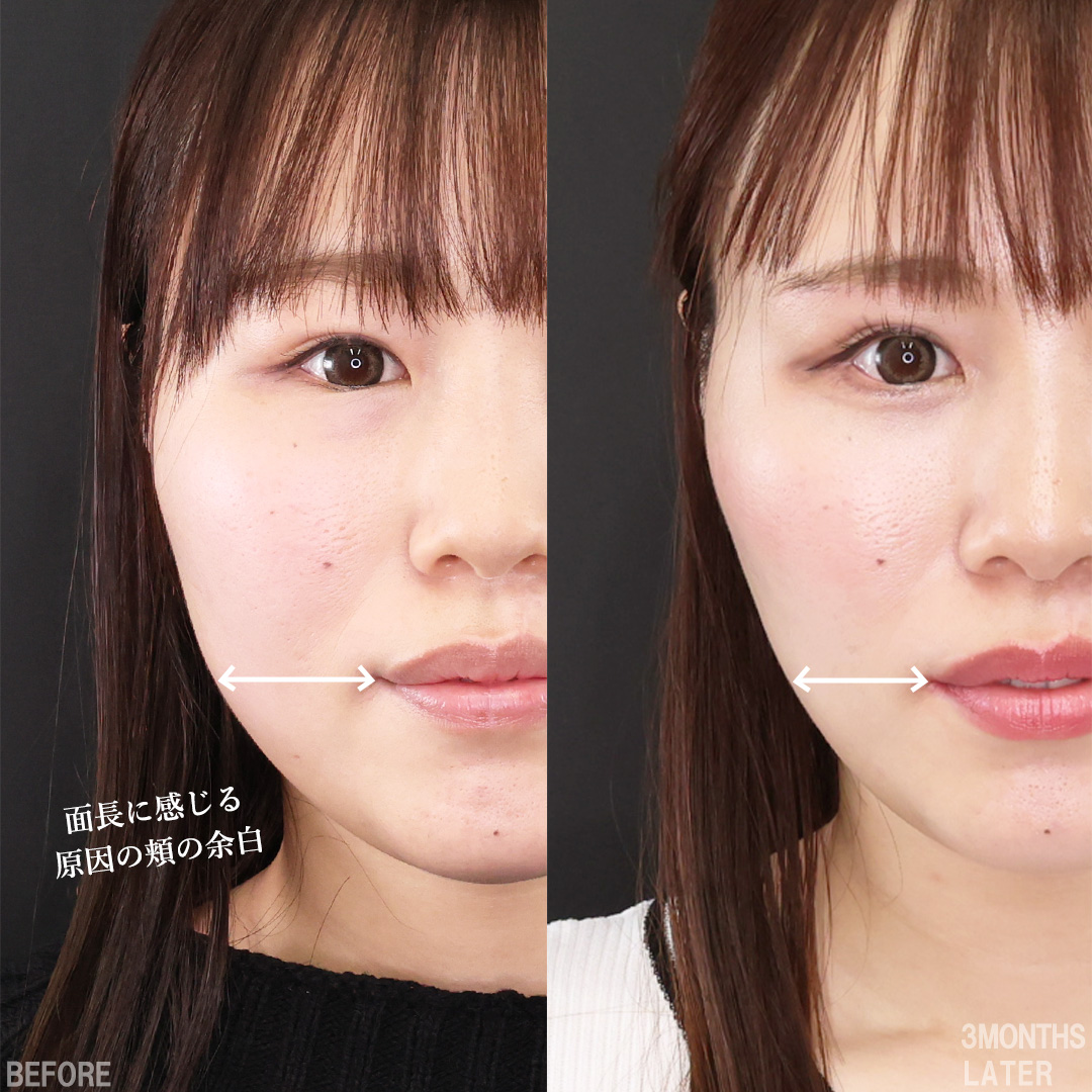 TAC式 ツヤ肌コラーゲンリフト®/バッカルファット除去/ジョールファット除去の症例写真 施術前後 