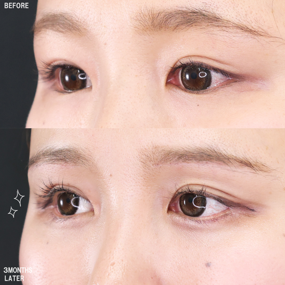 TAC式 ツヤ肌コラーゲンリフト®/バッカルファット除去/ジョールファット除去の症例写真 施術前後 