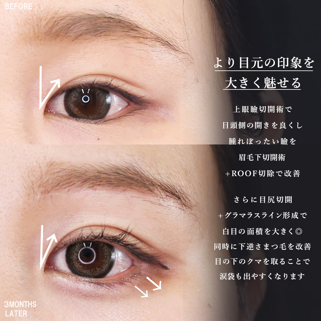 TAC式 ツヤ肌コラーゲンリフト®/バッカルファット除去/ジョールファット除去の症例写真 施術前後 