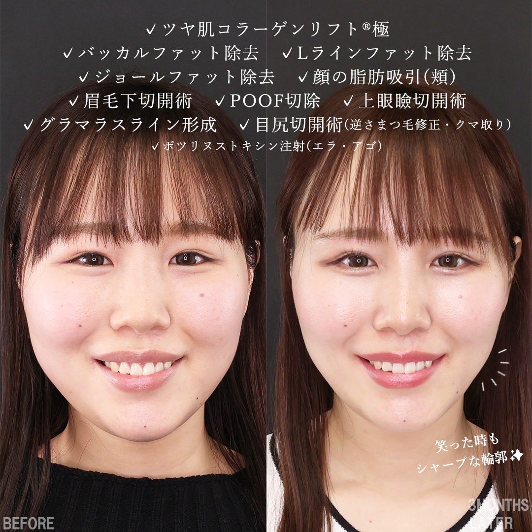 TAC式 ツヤ肌コラーゲンリフト®/バッカルファット除去/ジョールファット除去の症例写真 施術前後 