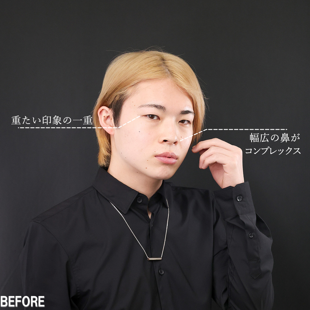 上眼瞼切開術/目頭切開術/グラマラスライン（タレ目形成）の症例写真 施術前後 