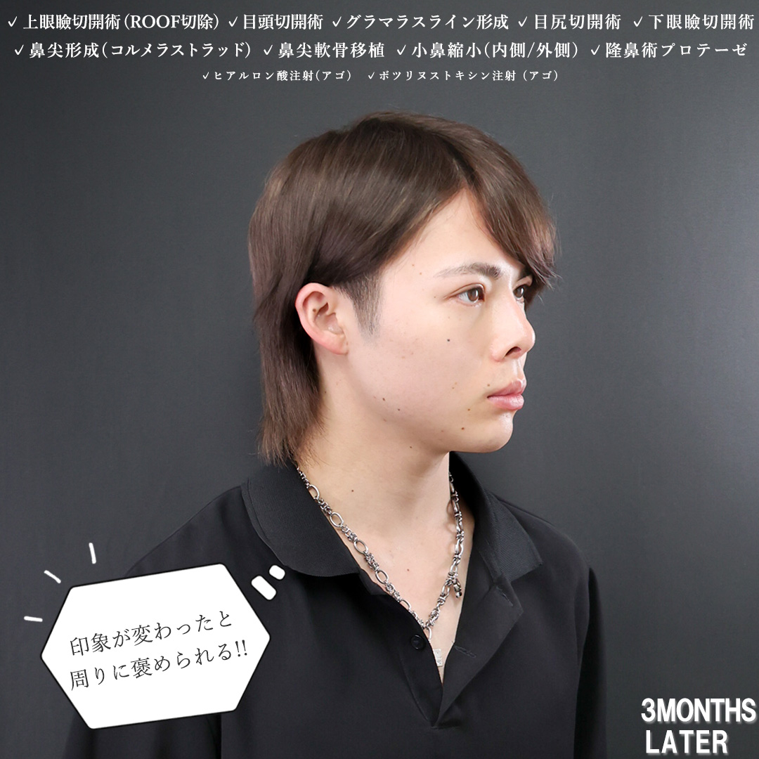 上眼瞼切開術/目頭切開術/グラマラスライン（タレ目形成）の症例写真 施術前後 