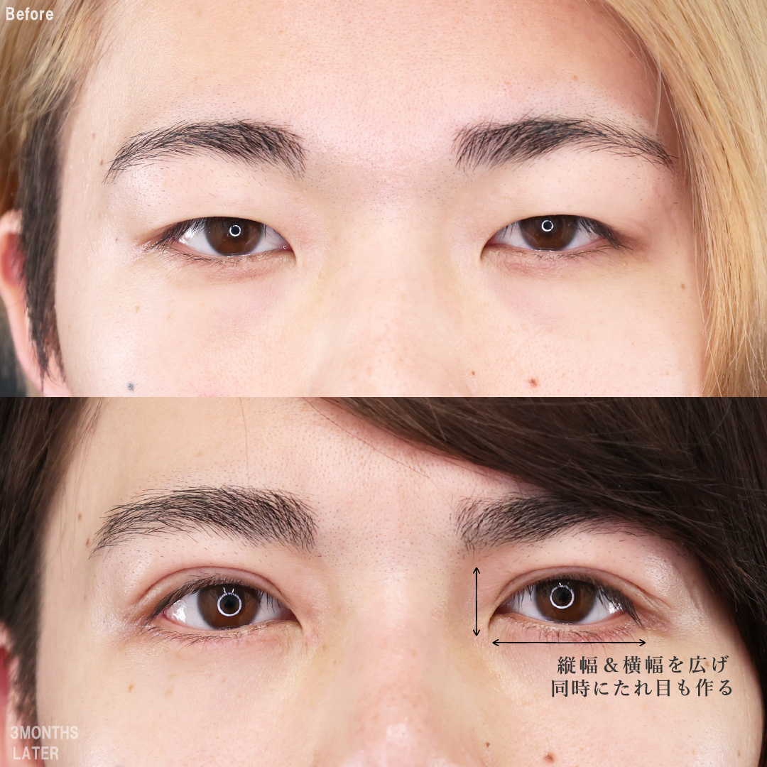 上眼瞼切開術/目頭切開術/グラマラスライン（タレ目形成）の症例写真 施術前後 