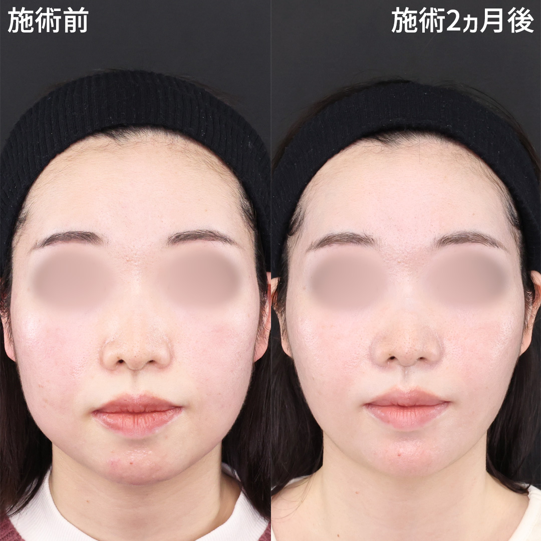 《脂肪吸引×糸リフト》小顔施術で頬の厚みをスッキリと！！