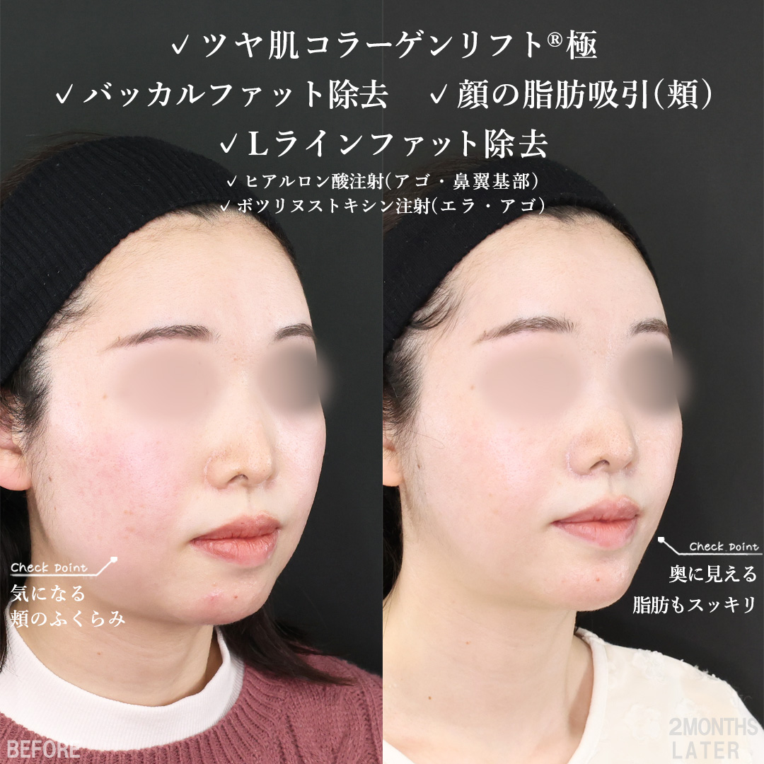 TAC式 ツヤ肌コラーゲンリフト®/バッカルファット除去/Lラインファット除去（エラ下脂肪除去）の症例写真 施術前後 