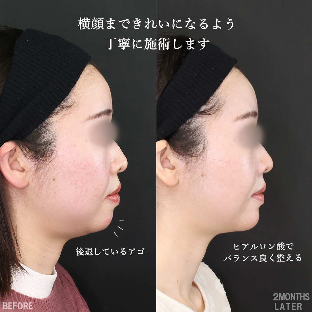 TAC式 ツヤ肌コラーゲンリフト®/バッカルファット除去/Lラインファット除去（エラ下脂肪除去）の症例写真 施術前後 