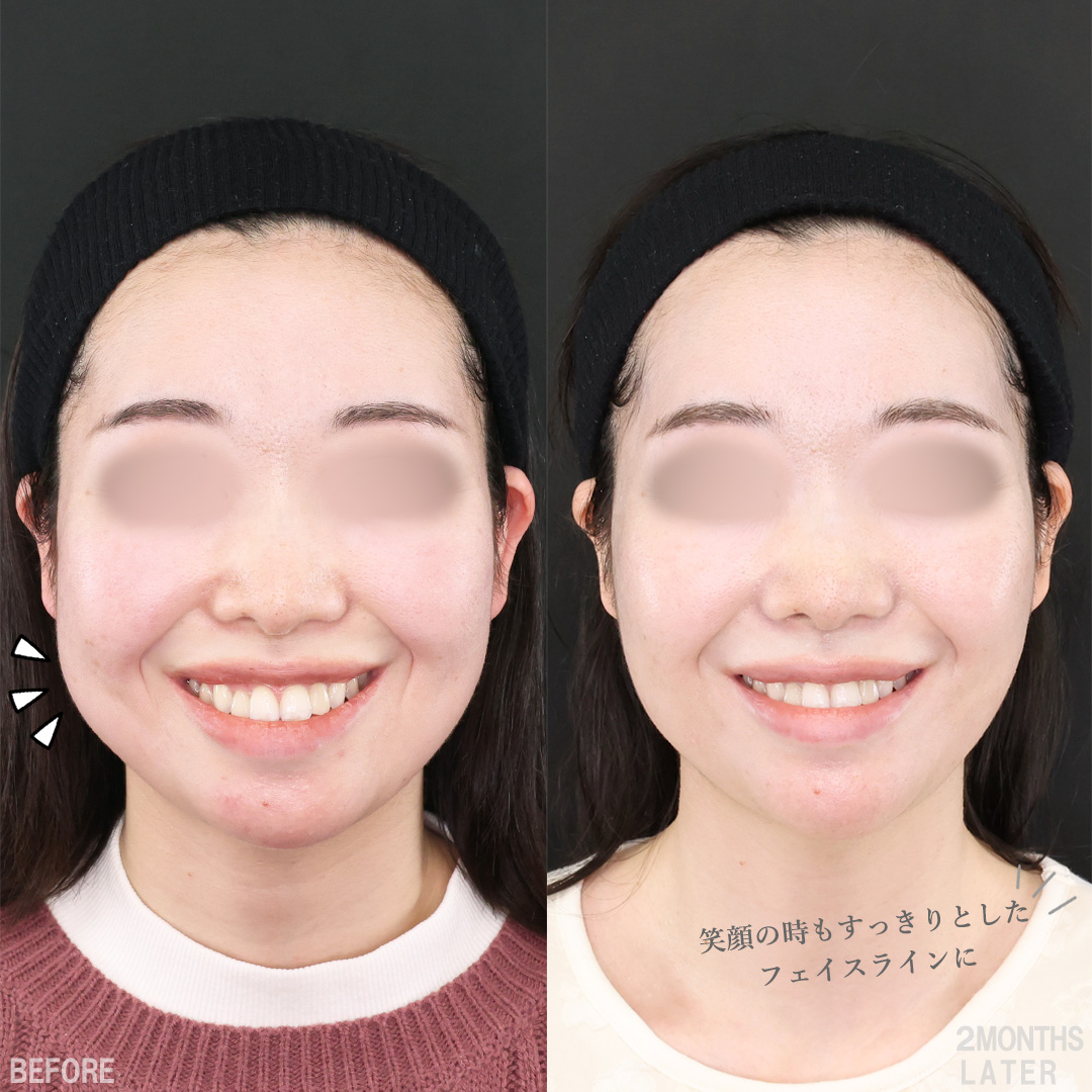 TAC式 ツヤ肌コラーゲンリフト®/バッカルファット除去/Lラインファット除去（エラ下脂肪除去）の症例写真 施術前後 