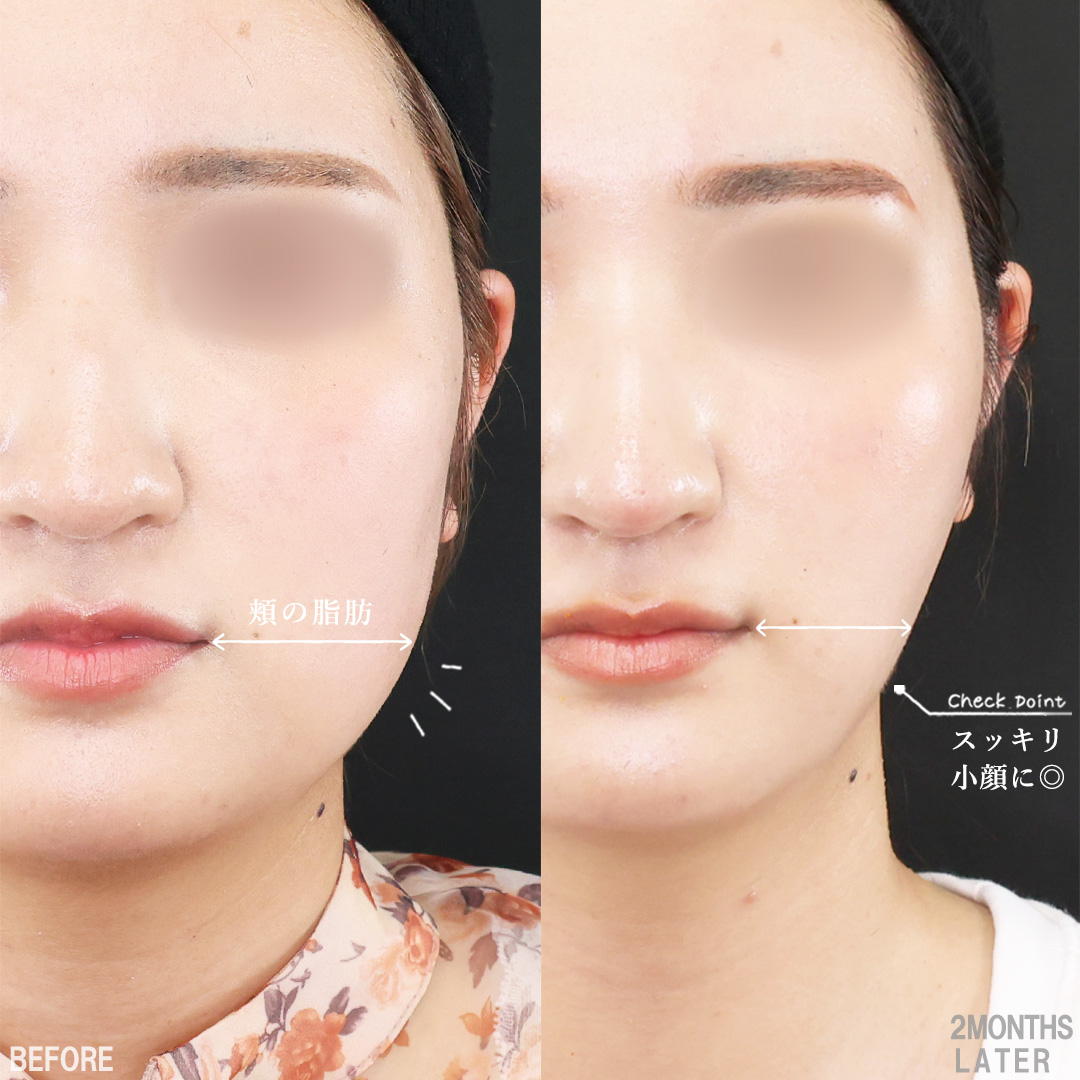 TAC式 ツヤ肌コラーゲンリフト®/バッカルファット除去/Lラインファット除去(エラ下脂肪除去)の症例写真 施術前後