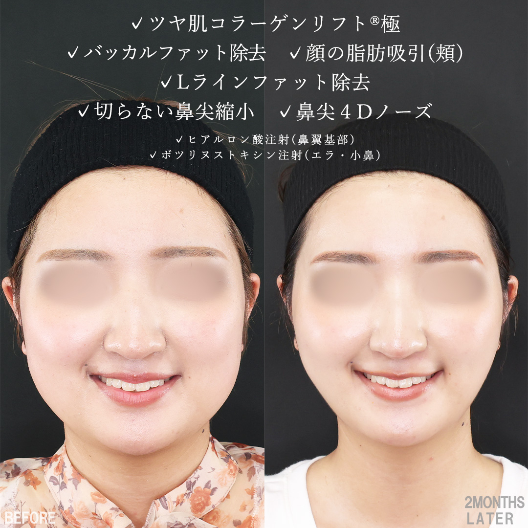 TAC式 ツヤ肌コラーゲンリフト®/バッカルファット除去/Lラインファット除去(エラ下脂肪除去)の症例写真 施術前後