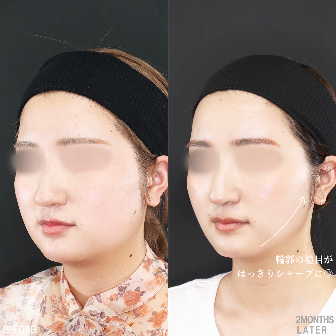 TAC式 ツヤ肌コラーゲンリフト®/バッカルファット除去/Lラインファット除去(エラ下脂肪除去)の症例写真 施術前後