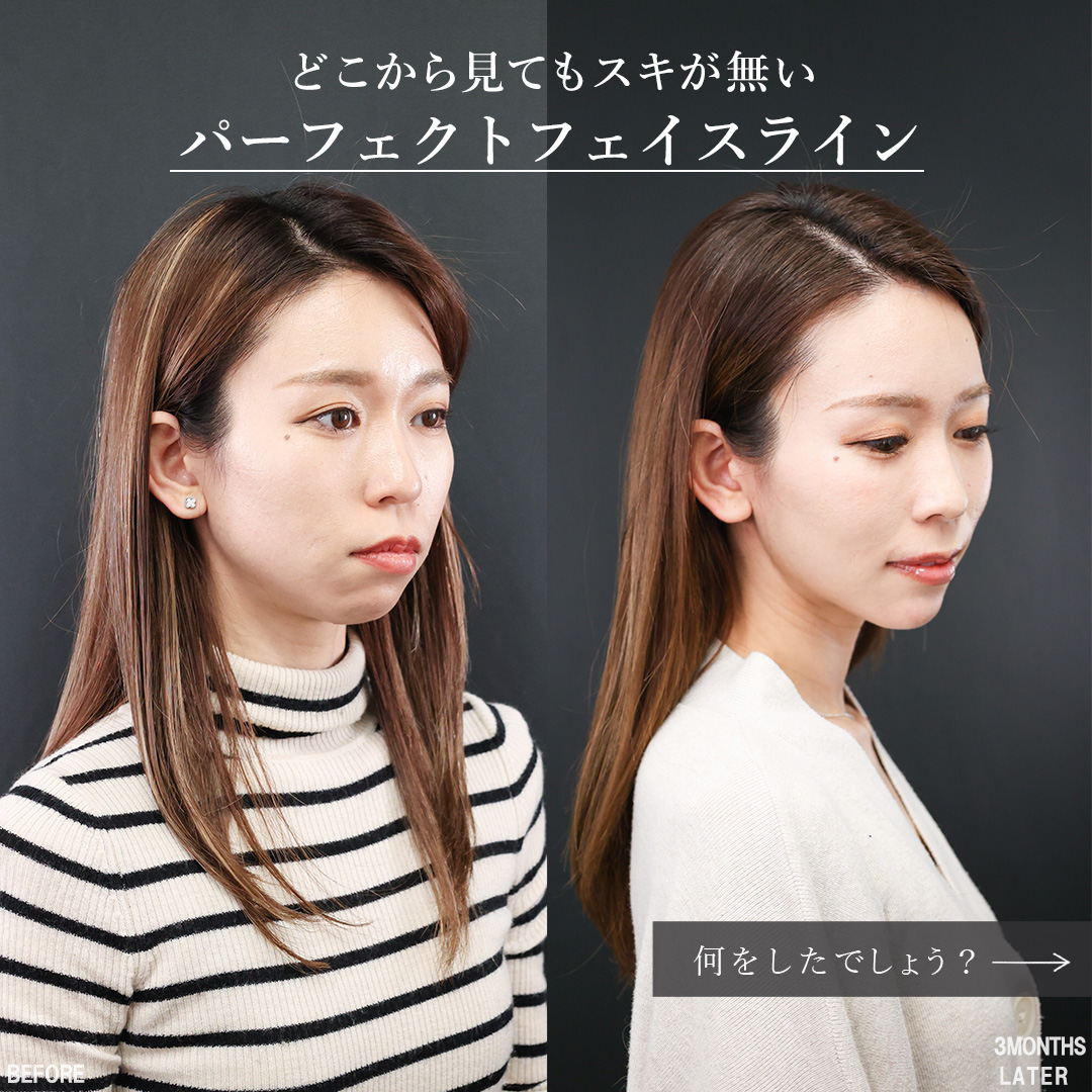 TAC式 ツヤ肌コラーゲンリフト®/口角挙上・リフト（マイクロ切開法・内側法/口内法）/Cカール・猫手術の症例写真 施術前後 