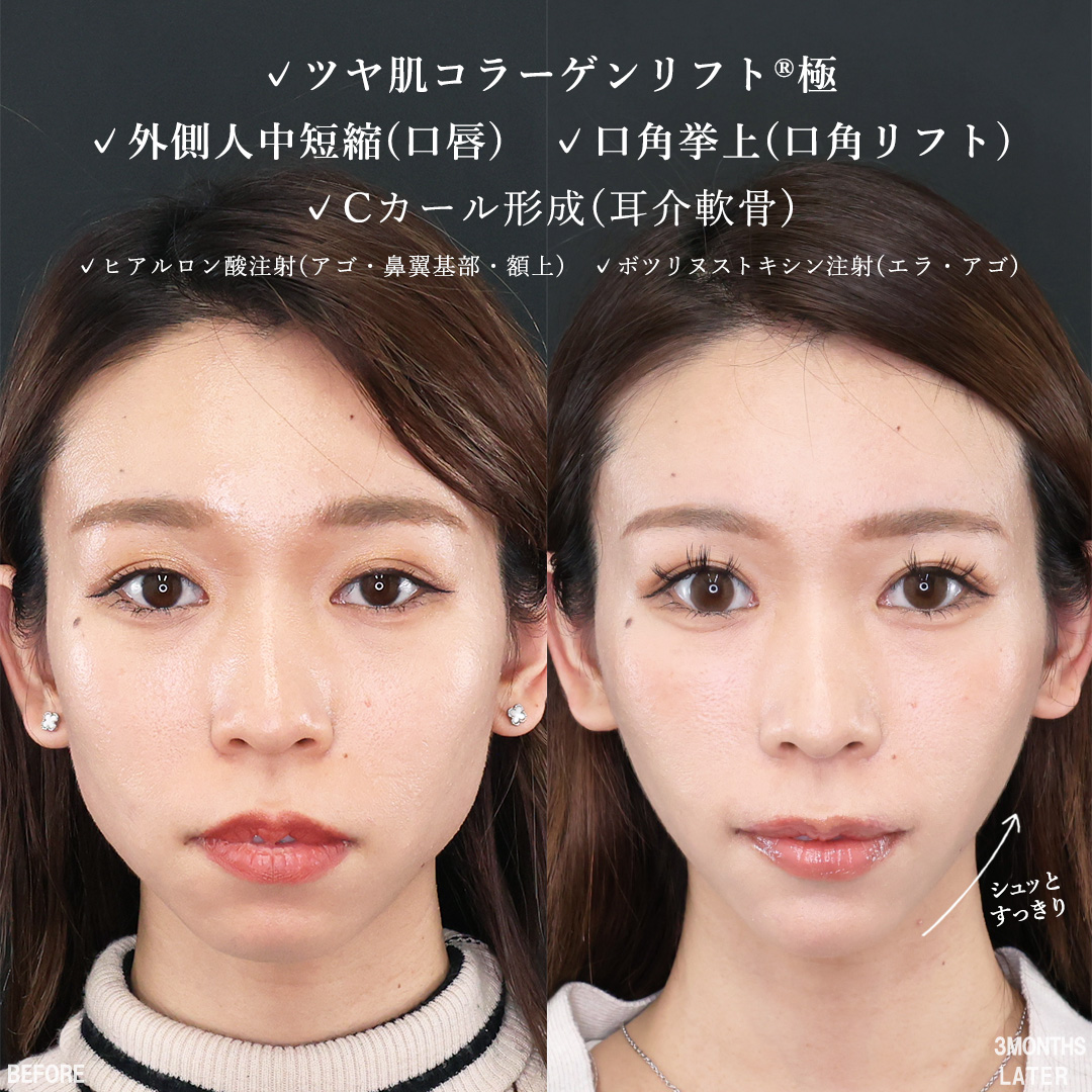 TAC式 ツヤ肌コラーゲンリフト®/口角挙上・リフト（マイクロ切開法・内側法/口内法）/Cカール・猫手術の症例写真 施術前後 