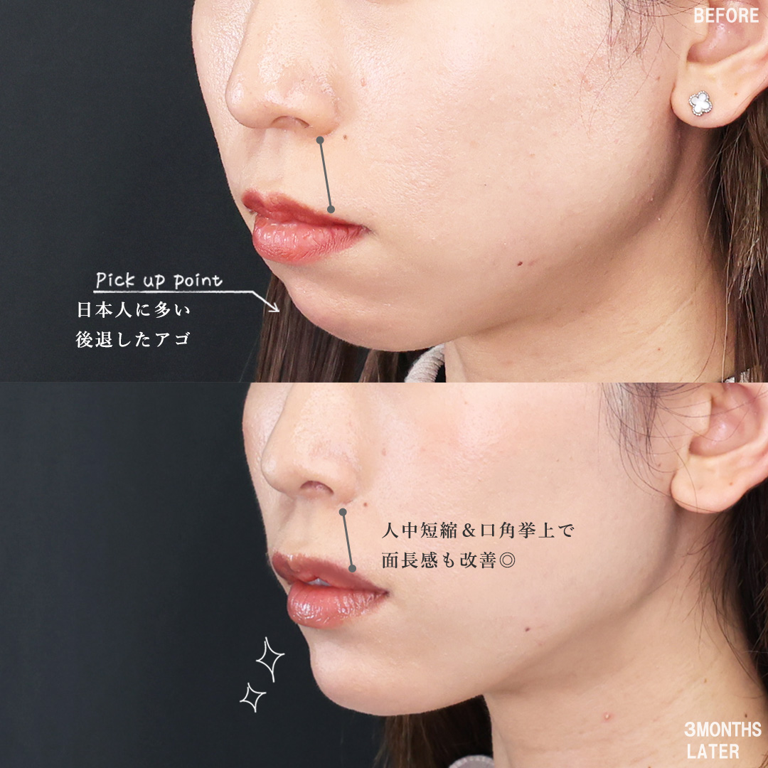 TAC式 ツヤ肌コラーゲンリフト®/口角挙上・リフト（マイクロ切開法・内側法/口内法）/Cカール・猫手術の症例写真 施術前後 