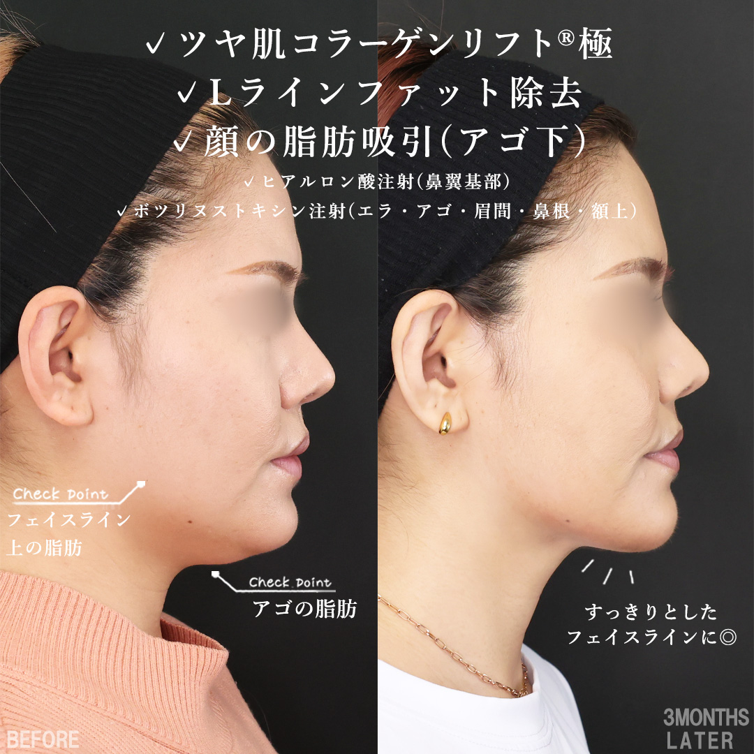TAC式 ツヤ肌コラーゲンリフト®/Lラインファット除去(エラ下脂肪除去)/顔の脂肪吸引の症例写真 施術前後