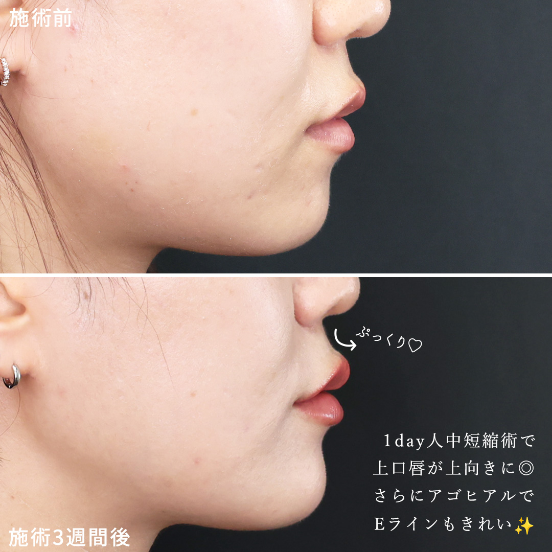 人中短縮術(リップリフト)・外側人中短縮術/顎のヒアルロン酸注射/ヒアルロン酸注射：その他の症例写真 施術前後 