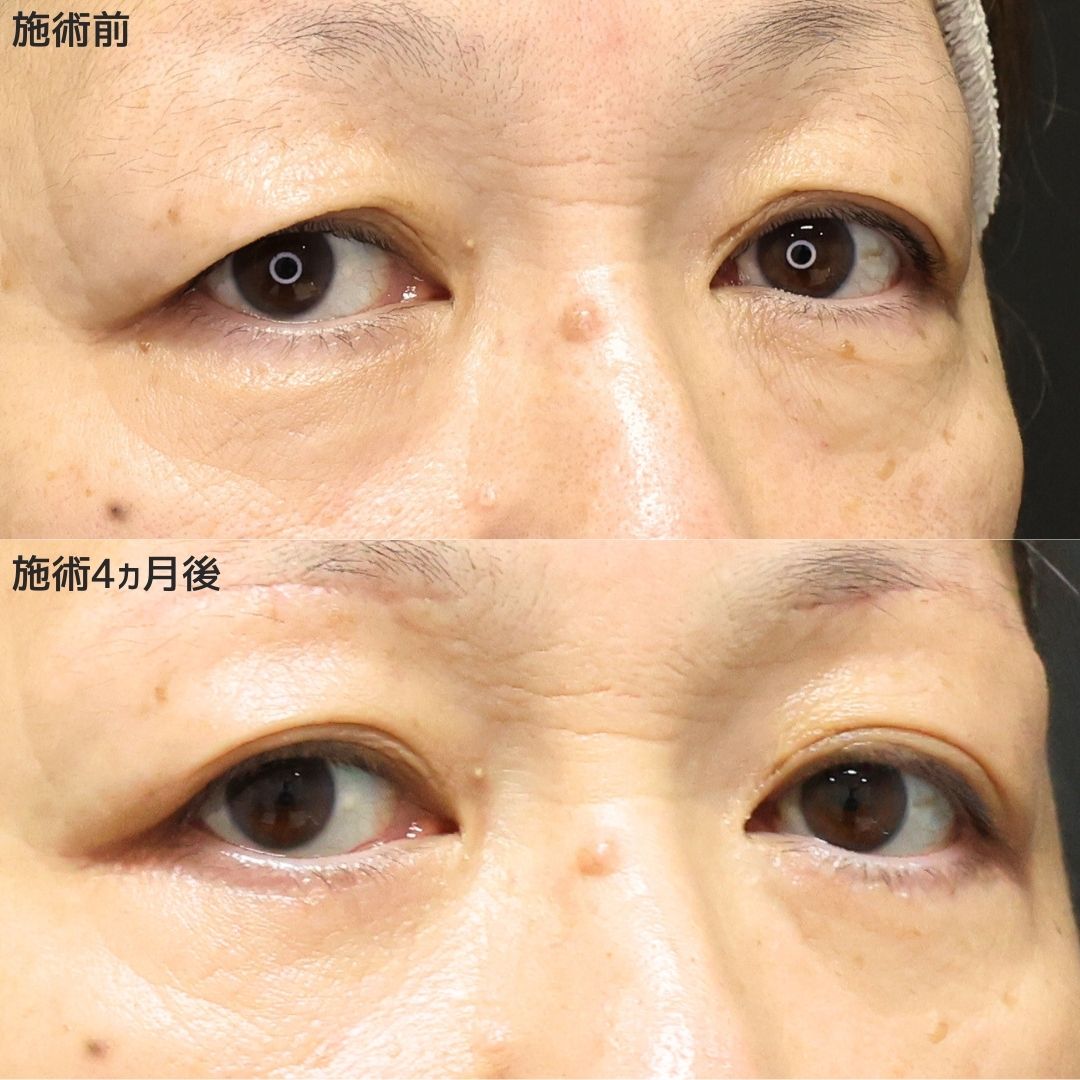 眉毛下切開術の症例写真 施術前後