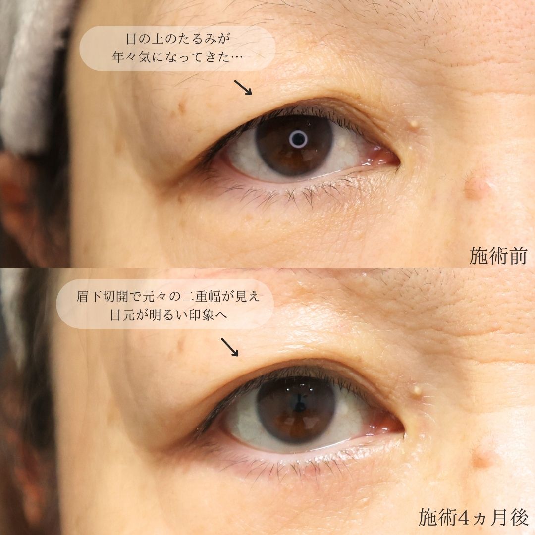 眉毛下切開術の症例写真 施術前後