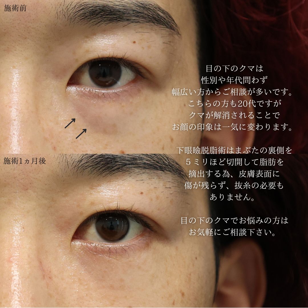 下眼瞼脱脂術(目の下のたるみ取り・目の下の脂肪ふくらみ取り)の症例写真 施術前後