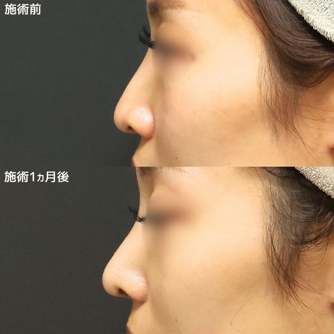 鼻尖形成・鼻尖縮小/鼻先軟骨移植/TAC式 鼻翼縮小術(小鼻縮小)の症例写真 施術前後